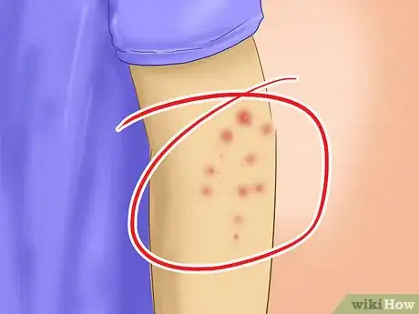 Imagem intitulada Avoid Catching Scabies Step 7