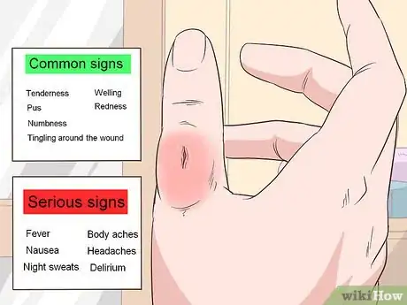 Imagem intitulada Remove a Deep Splinter Step 14