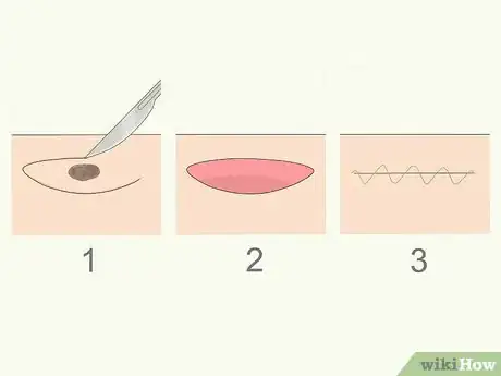 Imagem intitulada Remove Moles Quickly Step 4