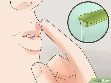 Imagem intitulada Cure a Cold Sore Fast Step 9