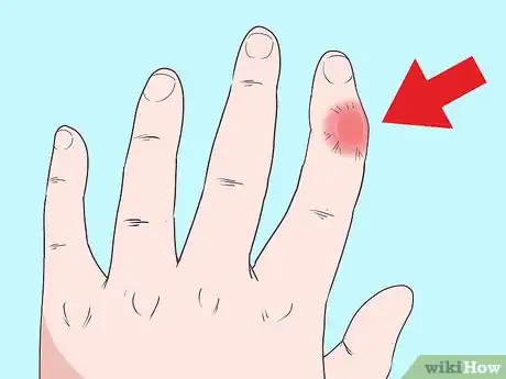 Imagem intitulada Fix a Dislocated Finger Step 1