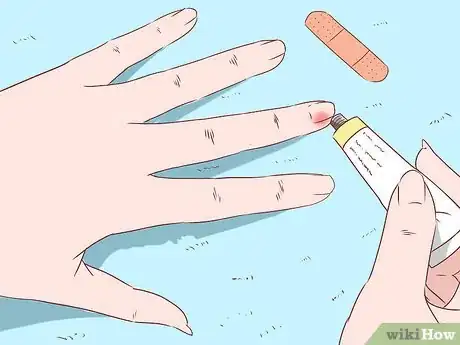 Imagem intitulada Remove a Splinter Step 10