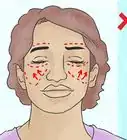 Reduzir a Gordura Facial