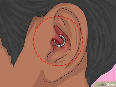 Imagem intitulada Clean a Daith Piercing Step 11