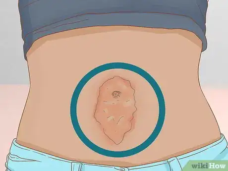 Imagem intitulada Clean Your Belly Button Step 6