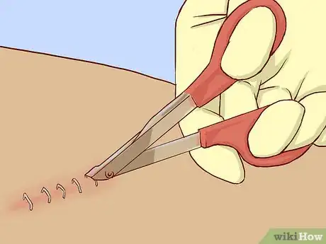 Imagem intitulada Remove Surgical Staples Step 2