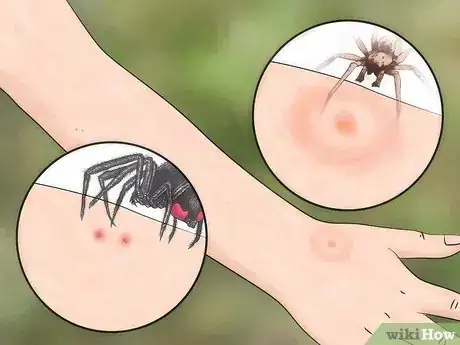 Imagem intitulada Identify Insect Bites Step 7