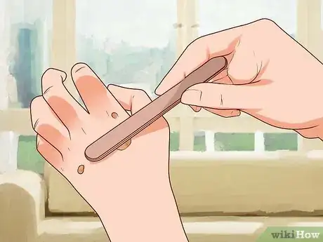 Imagem intitulada Remove Warts Naturally Using Garlic Step 6