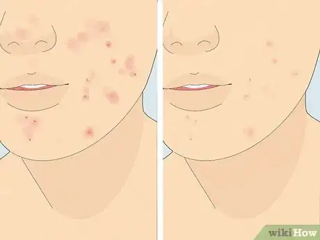 Imagem intitulada Reduce Acne Using Tomatoes Step 2