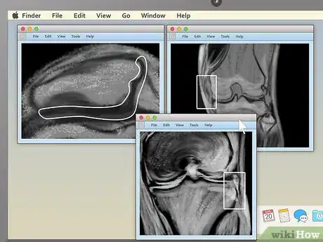 Imagem intitulada Read an MRI Step 14