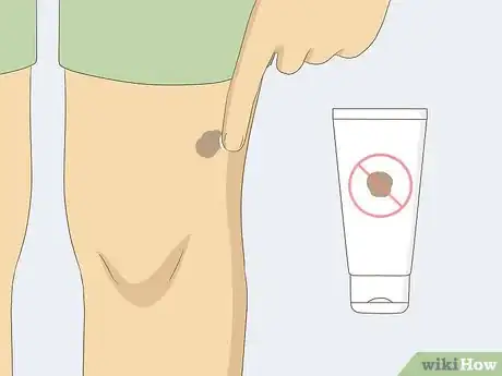Imagem intitulada Remove Moles Quickly Step 17