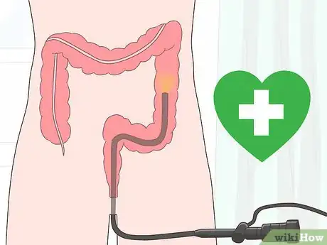 Imagem intitulada Detect Rectal Cancer Step 7