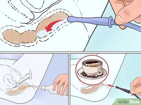 Imagem intitulada Administer an Enema Step 11