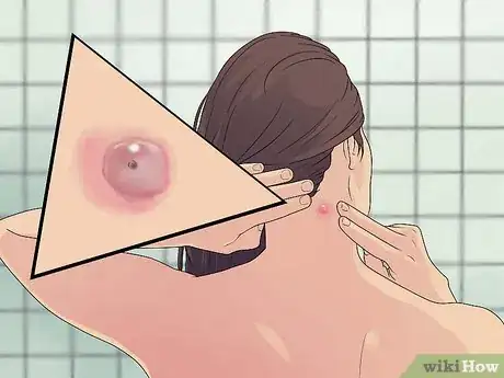 Imagem intitulada Remove a Sebaceous Cyst Step 1