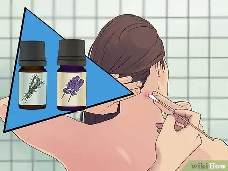 Imagem intitulada Remove a Sebaceous Cyst Step 5