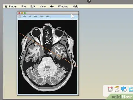 Imagem intitulada Read an MRI Step 9