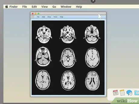 Imagem intitulada Read an MRI Step 8