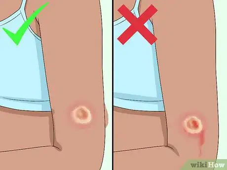 Imagem intitulada Get Rid of a Scab Step 1