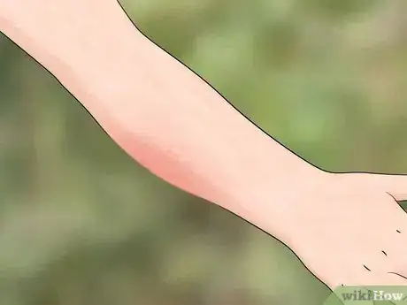 Imagem intitulada Identify Insect Bites Step 3