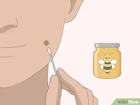 Imagem intitulada Remove Moles Quickly Step 15
