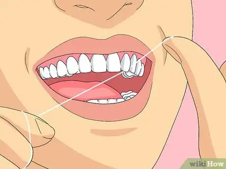 Imagem intitulada Clean Invisalign Step 4