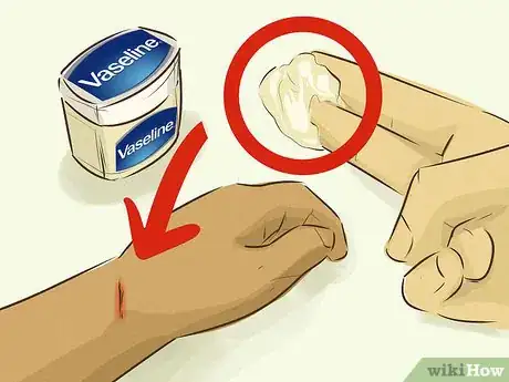 Imagem intitulada Stop Bleeding Step 2