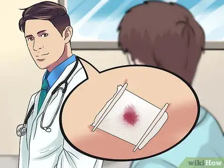 Imagem intitulada Remove a Sebaceous Cyst Step 4