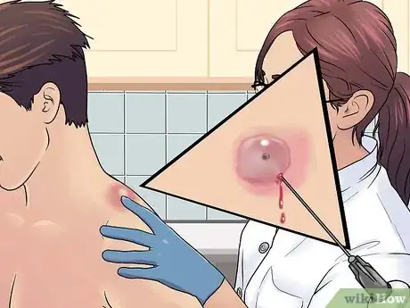 Imagem intitulada Remove a Sebaceous Cyst Step 3