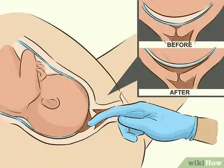 Imagem intitulada Go Into Labor Early Step 4