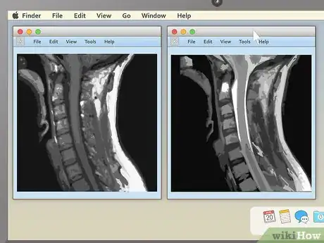 Imagem intitulada Read an MRI Step 7