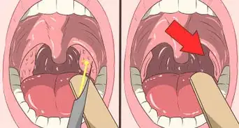 Remover Pedras das Amígdalas (Amigdalites)