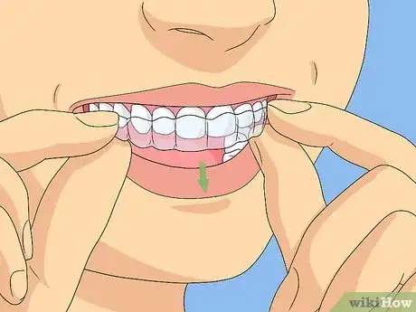Imagem intitulada Clean Invisalign Step 1