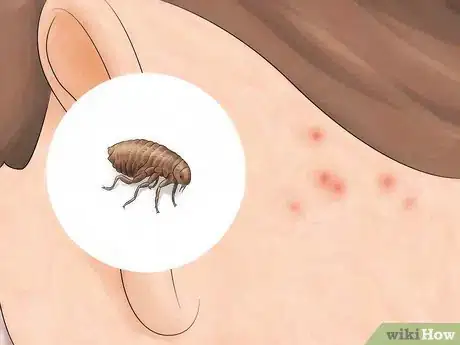 Imagem intitulada Identify Insect Bites Step 6