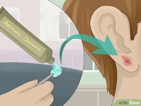 Imagem intitulada Clean an Infected Ear Piercing Step 4