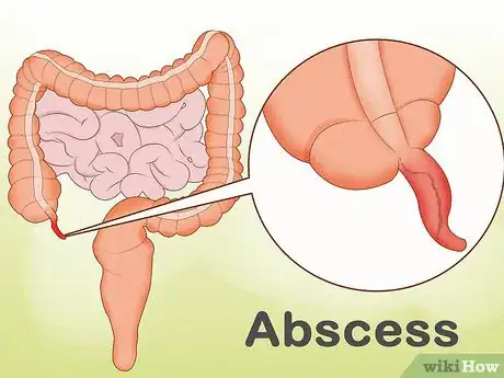 Imagem intitulada Reduce Appendix Pain Step 9
