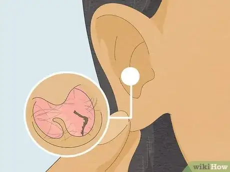 Imagem intitulada Remove a Bug from Your Ear Step 11