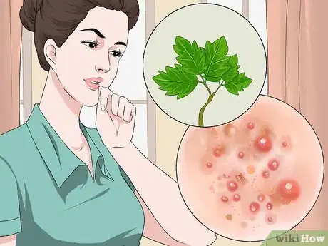 Imagem intitulada Get Rid of Poison Oak Rash Step 13