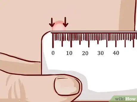 Imagem intitulada Read a Tuberculosis Skin Test Step 5