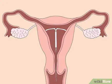 Imagem intitulada Shorten Your Period Step 2