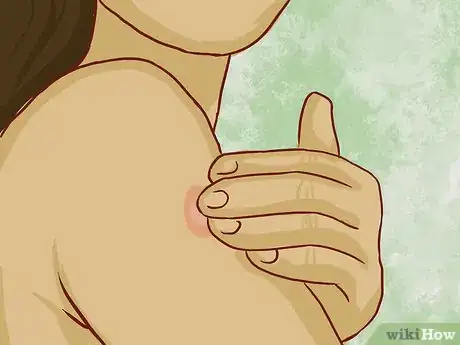 Imagem intitulada Read a Tuberculosis Skin Test Step 4