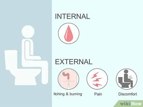 Imagem intitulada Get Rid of Hemorrhoids Fast Step 2