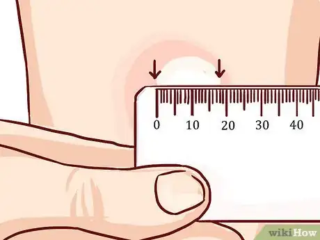 Imagem intitulada Read a Tuberculosis Skin Test Step 8