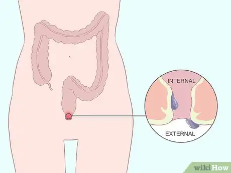Imagem intitulada Get Rid of Hemorrhoids Fast Step 1