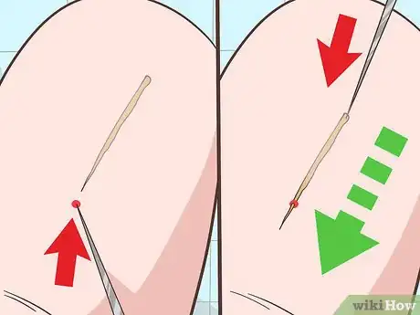 Imagem intitulada Remove a Deep Splinter Step 3