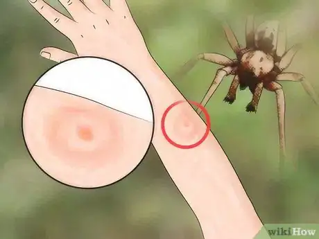 Imagem intitulada Identify a Spider Bite Step 2