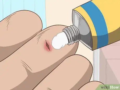 Imagem intitulada Remove a Deep Splinter Step 8