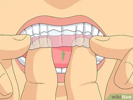 Imagem intitulada Clean Invisalign Step 5
