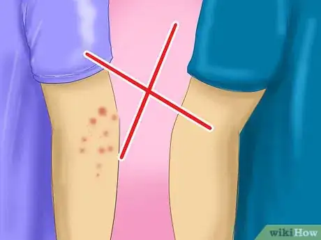 Imagem intitulada Avoid Catching Scabies Step 1