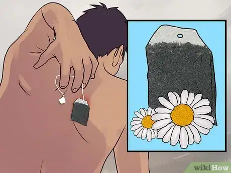 Imagem intitulada Remove a Sebaceous Cyst Step 10