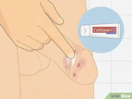 Imagem intitulada Cure Balanitis Step 3